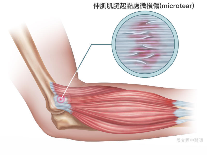 前臂伸肌肌腱的起點處反覆的微損傷microtear，不是發炎！