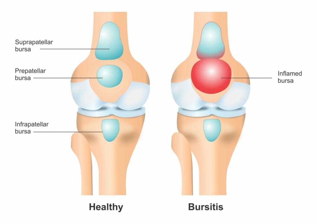髕骨前滑囊炎/膝蓋骨前滑囊炎相關結構